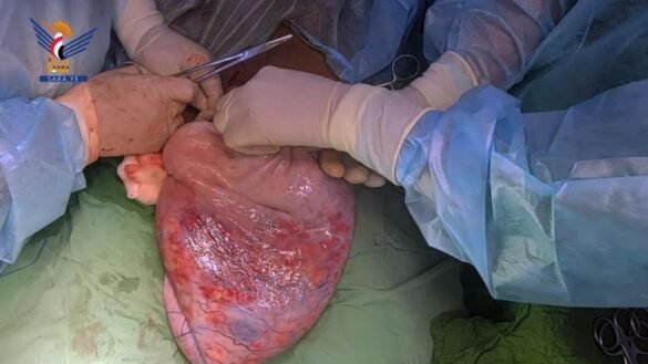 عملية جراحية ناجحة بمستشفى همدان بصنعاء