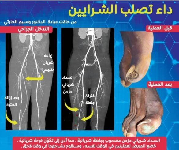 تعرف على مرض تصلب الشرايين الطرفية