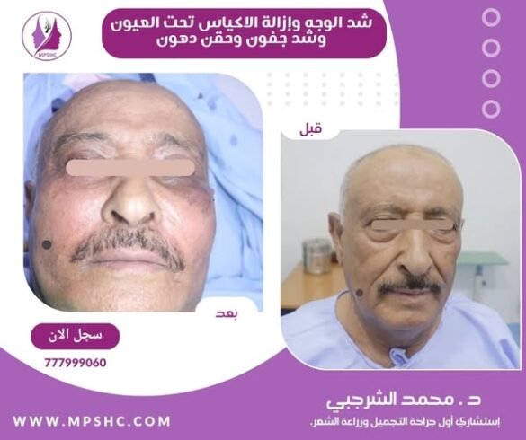 عملية شد الوجه في مركز الدكتور محمد الشرجبي