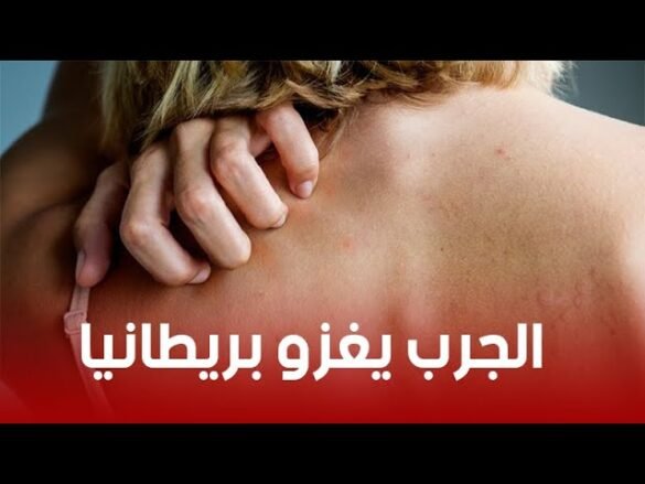 انتشار مرض الجرب في بريطانيا