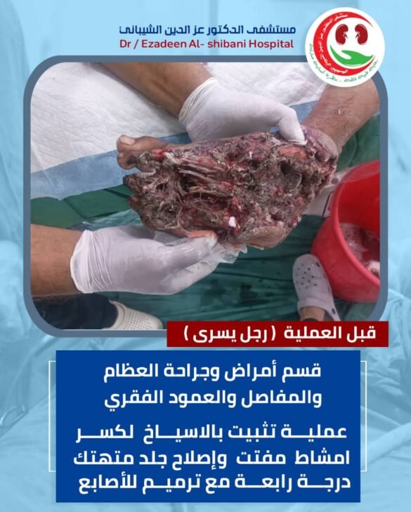 مستشفى الدكتورعزدين الشيباني ينقذ قدم مريض من البتر في عملية معقدة