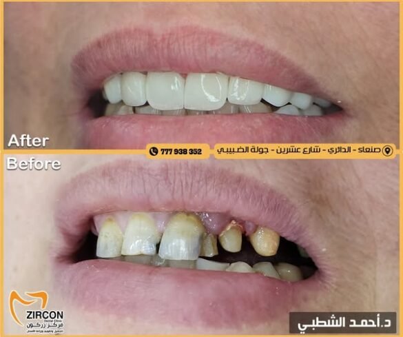 الدكتور أحمد الشطبي يصنع الفرق في مركز زركون ابتسامة تضيء بعد سنوات من المعاناة