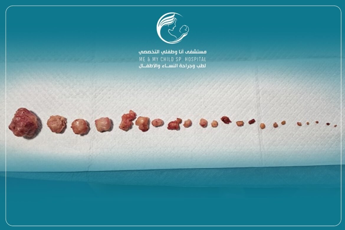 انجاز طبي بمستشفى أنا وطفلي التخصصي: استئصال ٢٣ ورما ليفيا بنجاح