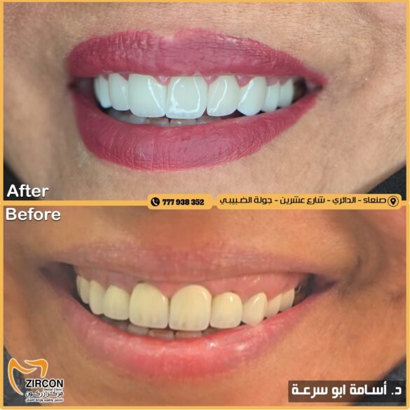 مركز زركون: من الخزف الباهت إلى ابتسامة متناسقة رحلة تجديد بقيادة الدكتورأسامة أبو سرعة