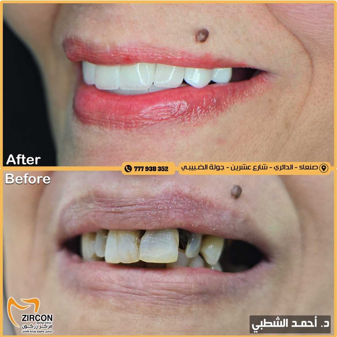 ابتسامة متناسقة تجمع بين الجمال والمتانة.. إنجاز جديد لمركز زركون بقيادة د. أحمد الشطبي