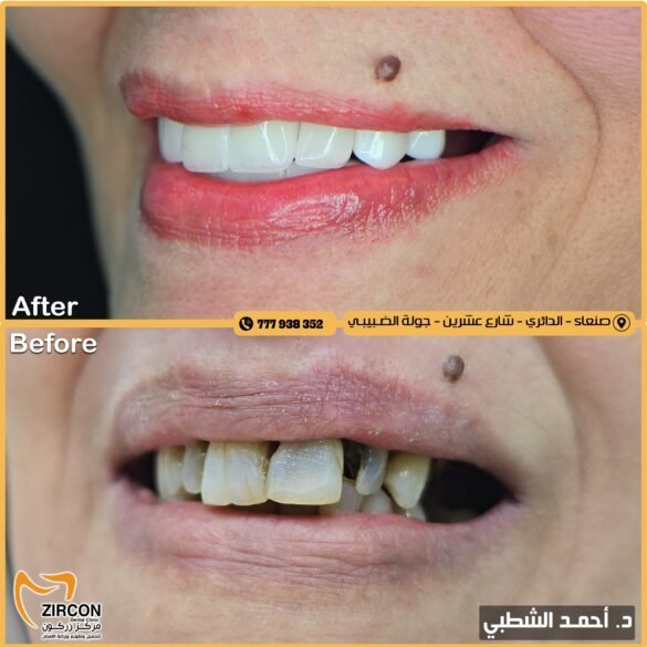 ابتسامة متناسقة تجمع بين الجمال والمتانة.. إنجاز جديد لمركز زركون بقيادة د. أحمد الشطبي