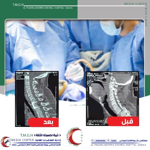 إنجاز طبي بارز بمستشفى الثورة: عملية نوعية تثبيت كسر لفقرات العنق بالعمود الفقري تكلل بالنجاح