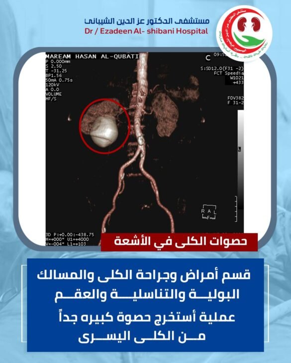 عملية نوعية في قسم الكلى والمسالك البولية بمستشفى الدكتورعزالدين الشيباني