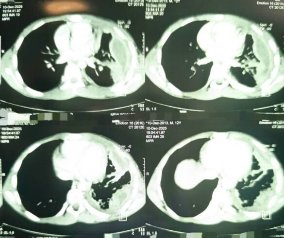 انطلاق خدمات جراحة الصدرالمتقدمة في مستشفى أنا وطفلي التخصصي وتسجيل نجاح طبي متميز في أول عملية فتح صدر وتقشير رئة