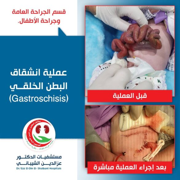 عملية دقيقة تنقذ حياة طفلة حديثة الولادة في مستشفى الدكتورعزالدين الشيباني